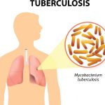 Tuberculosis Deaths