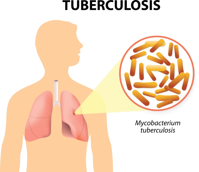 Tuberculosis Deaths